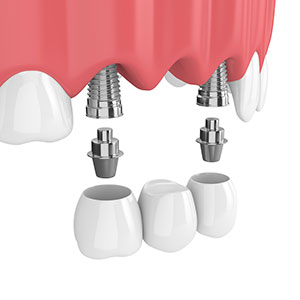 dental implant supported bridge